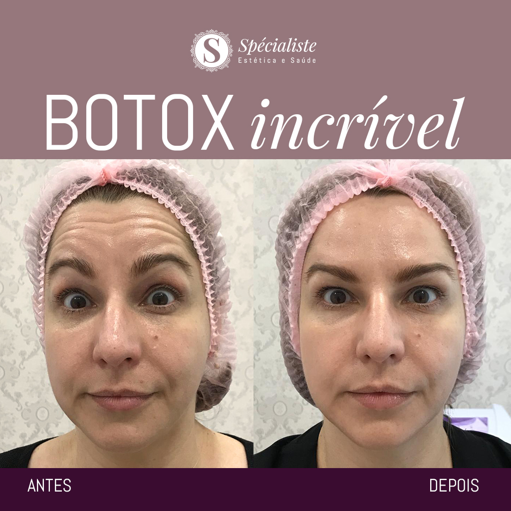 Botox - Toxina Botulínica